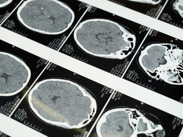 China’s ultrasound brain tech race heats up